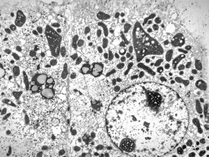 F,17y. | megamitochondria - Wilson disease F,17y. | megamitochondria - Wilson disease